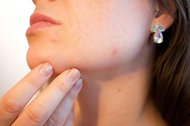 Traitement de l'acné avec l'ozone et la l'ozonothérapie